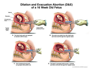 Diagram of a dismemberment abortion
